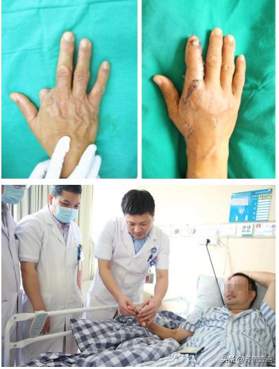 手指缺失10級(jí)傷殘圖九級(jí)傷殘一共賠幾萬(wàn)插圖