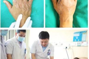 手指缺失10級傷殘圖九級傷殘一共賠幾萬